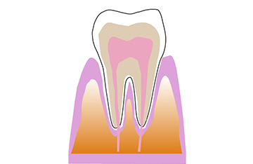 CO初期段階の虫歯